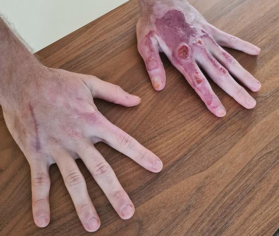 Руки Романа Грожана. Фото из Instagram гонщика Руки Романа Грожана. Фото из Instagram гонщика